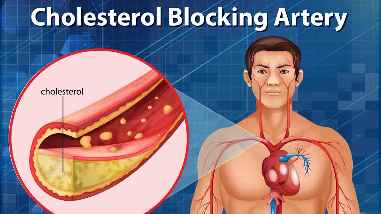Cholesterol : उच्च कोलेस्ट्रॉल के लक्षण क्या हैं ?