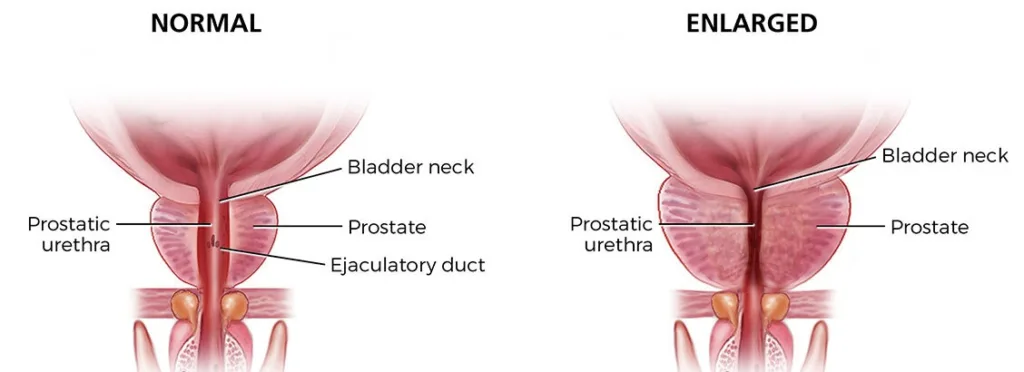 prostate प्रोस्टेट क्यों बढ़ गया है ?