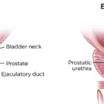 prostate प्रोस्टेट क्यों बढ़ गया है ?