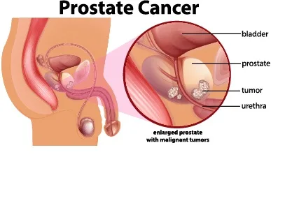 Prostate Cancer : क्या बार-बार हस्तमैथुन करना मनुष्य के स्वास्थ्य के लिए फायदेमंद है या इससे प्रोस्टेट कैंसर का खतरा बढ़ जाता है ?
